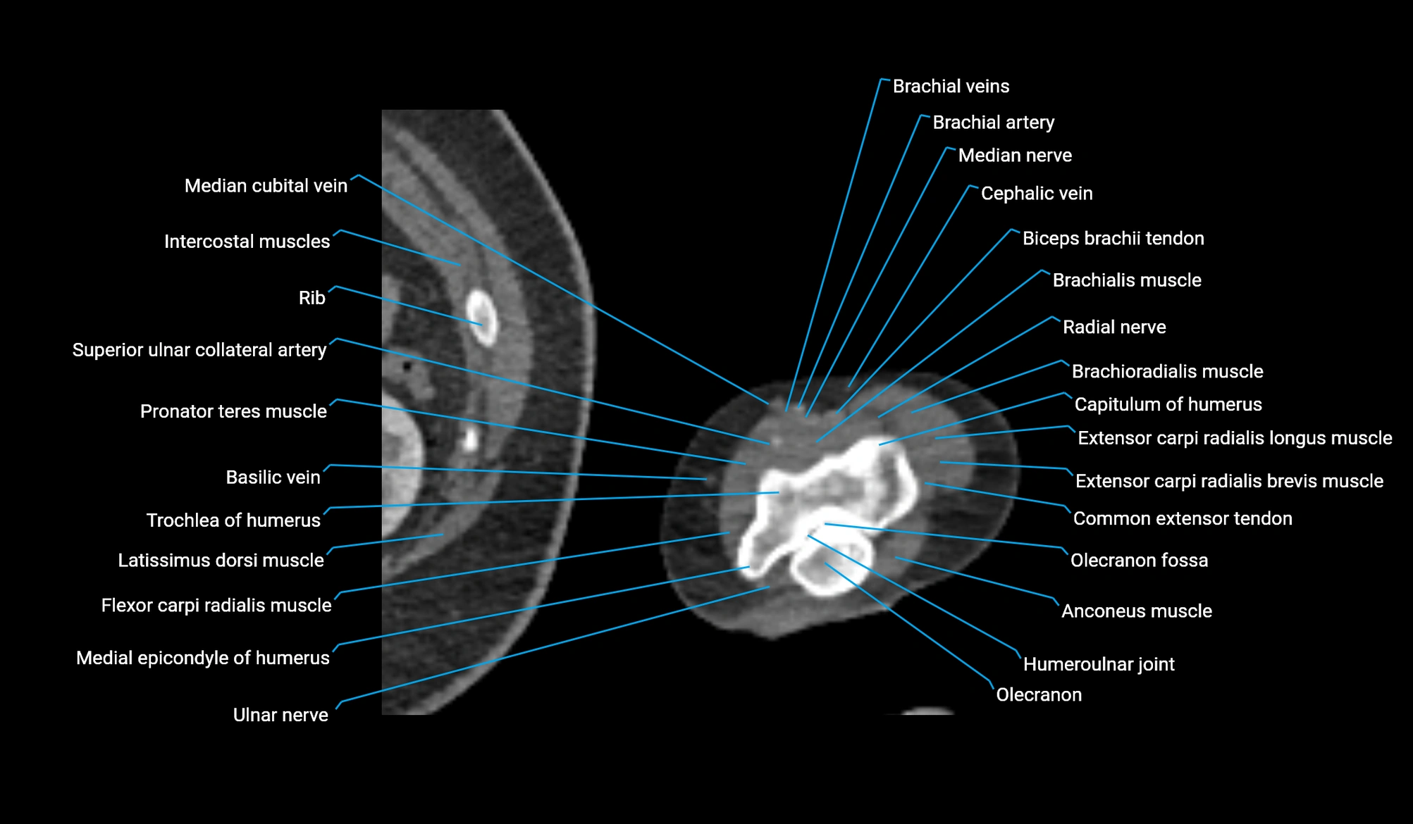 CT upper arm axial  cross sectional anatomy labelled radiology image -00386.webp